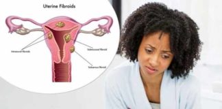 hair loss fibroids and ethnicity is there any association