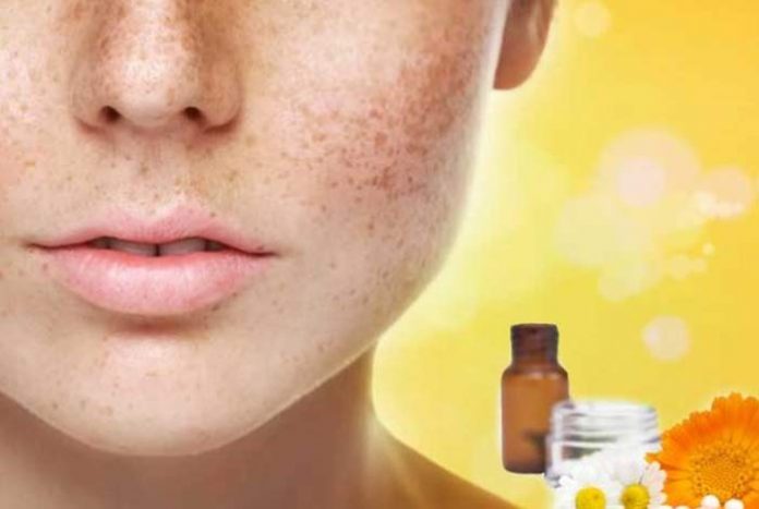 homeopathic all natural ways to cure face pigmentation