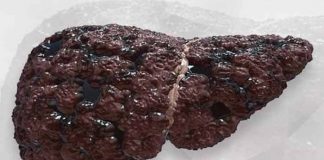 liver cirrhosis symptoms causes diagnosis prevention and treatment