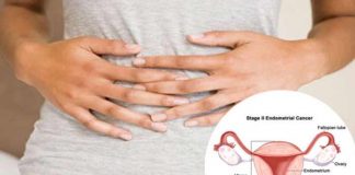 ovarian cancer types symptoms causes diagnosis and treatment
