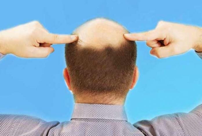 restores your hair growth home-remedies for baldness in men