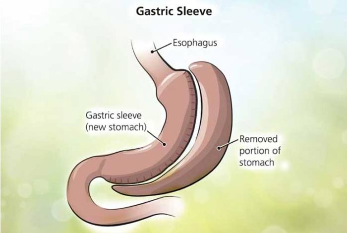 sleeve gastrectomy surgery