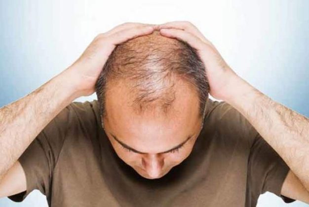 Top 17 Effectively Useful Home Remedies For Baldness