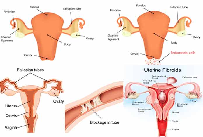 Causes of Female Infertility 