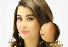Easy Acne Scars Treatment with Dr. Harold Lancer