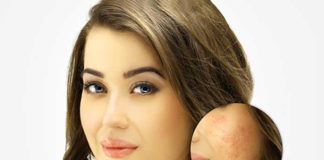 Easy Acne Scars Treatment with Dr. Harold Lancer