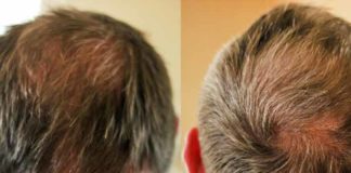 Hair Thinning -- Reasons and Cure