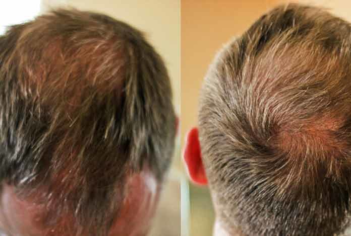 Hair Thinning -- Reasons and Cure