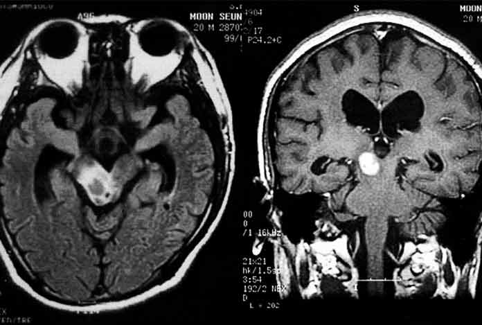 Increase tremor for Cannabidiol — Benefits and Effects