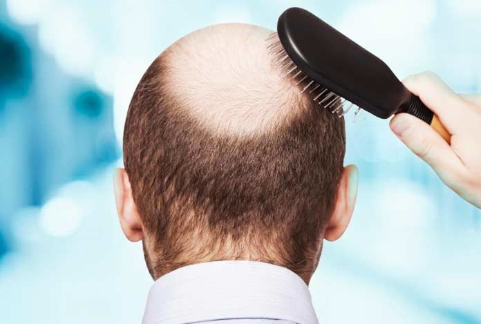 Is Hair Loss Related to Age?