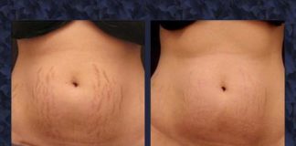 Stretch Marks Removal Tips by Dr. Harold Lancer