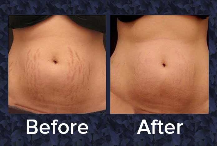 Stretch Marks Removal Tips by Dr. Harold Lancer