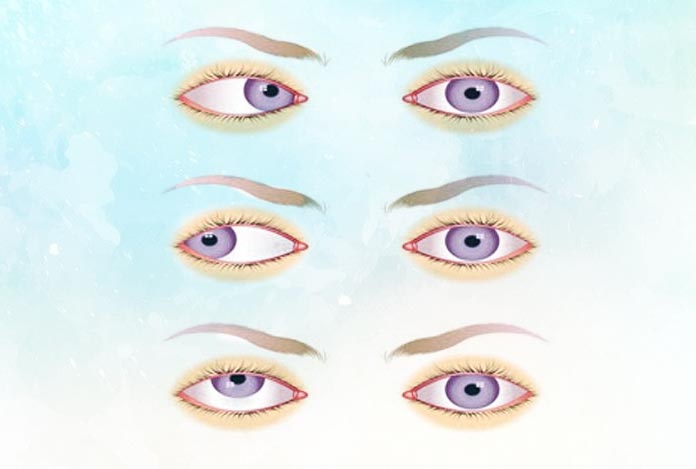 Types of Nystagmus