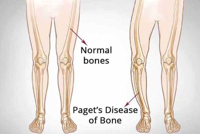 causes of paget’s disease of bone