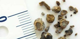 kidney stone symptoms causes prevention and treatment