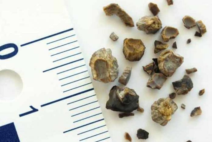 kidney stone symptoms causes prevention and treatment