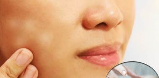 Easy-Ways-to-Prevent-and-Treat-White-Spots-by-Dr.-Harold-Lancer
