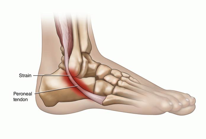 Peroneal Tendinitis