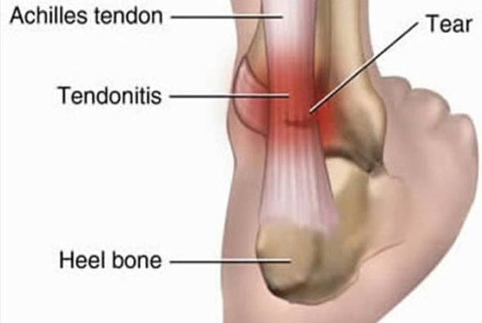 achilles tendinitis 