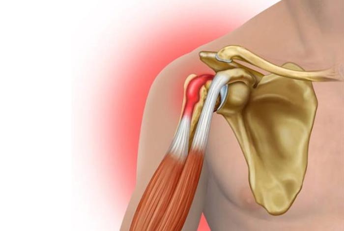 biceps tendinitis