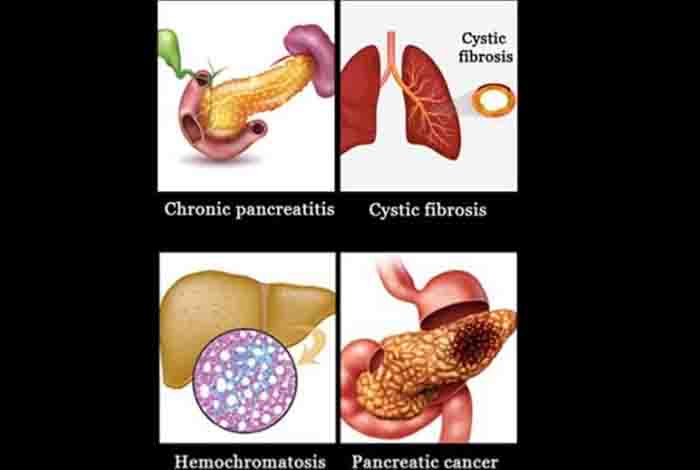 causes of type 3c diabetes