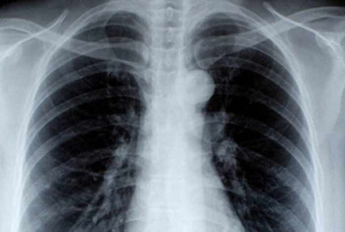 diagnosis and tests for copd