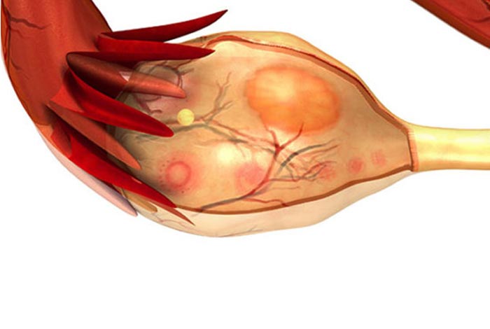 difference among polycystic ovary pco polycystic ovary disorder pcod and polycystic ovary syndrome pcos