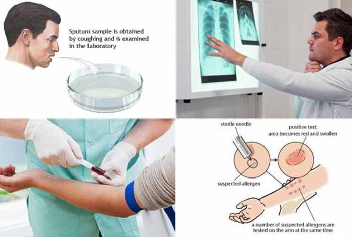 interferon gamma release assay