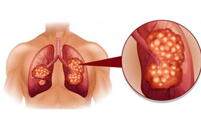 lung cancer types causes symptoms and treatment