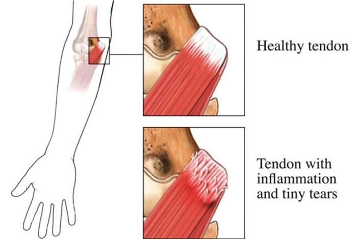 medial epicondylitis