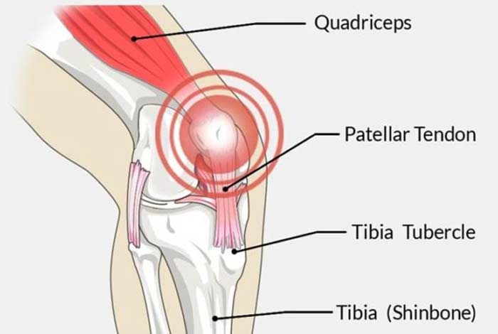 patellar tendinitis