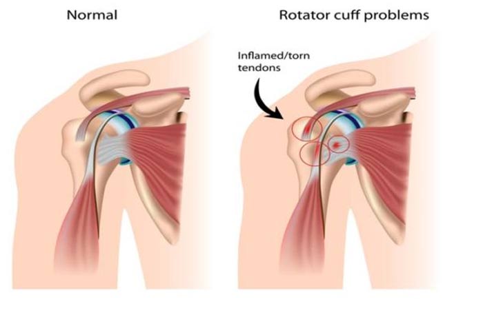 rotator cuff tendinitis