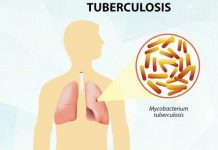 Tuberculosis – Causes, Symptoms and Treatment tuberculosis causes symptoms and treatment