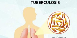 Tuberculosis – Causes, Symptoms and Treatment tuberculosis causes symptoms and treatment