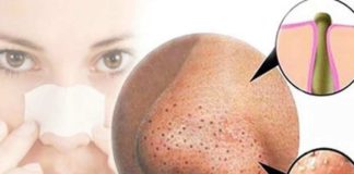 Simple Ways to Get Rid of Blackheads