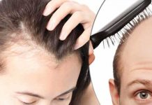 Alopecia- Types, Symptoms, Causes, Treatment alopecia types symptoms causes treatment