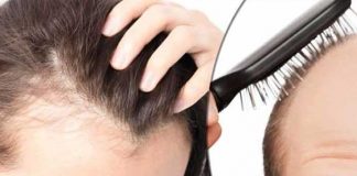 Alopecia- Types, Symptoms, Causes, Treatment alopecia types symptoms causes treatment