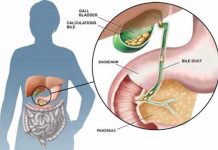 Gallstones (Cholelithiasis) and its Most Common Drug List gallstones cholelithiasis and its most common drug list