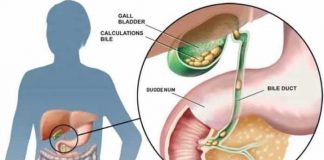 gallstones cholelithiasis and its most common drug list