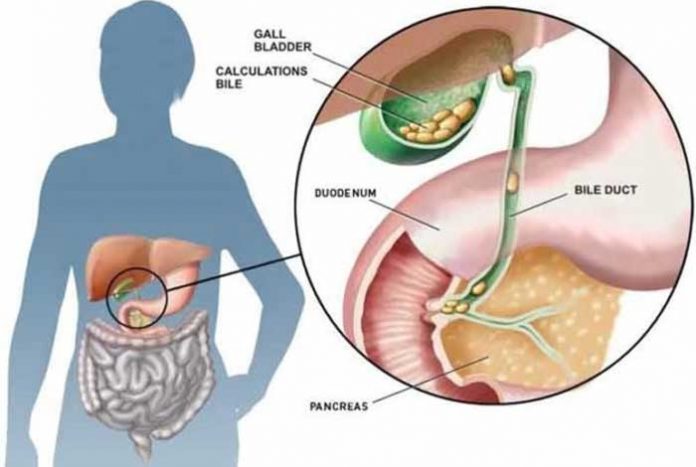 gallstones cholelithiasis and its most common drug list