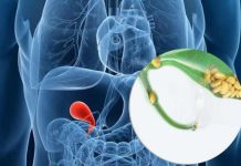 Gallstones – Causes, Symptoms, Prevention and Treatment gallstones causes symptoms prevention and treatment