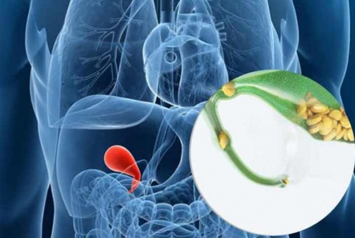 gallstones causes symptoms prevention and treatment