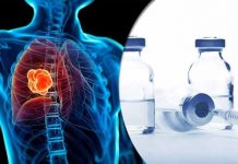Lung Cancer and Its Most Common Drug List lung cancer and its most common drug list