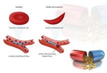 Sickle Cell Anemia and Its Most Common Drug List sickle cell anemia and its most common drug list