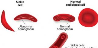 sickle cell anemia types symptoms causes diagnosis and treatment