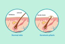 Dr. Lancer on Treating Keratosis Pilaris Dr. Lancer on Treating Keratosis Pilaris