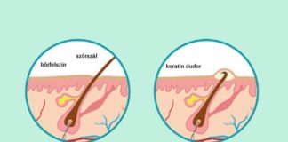 Dr. Lancer on Treating Keratosis Pilaris
