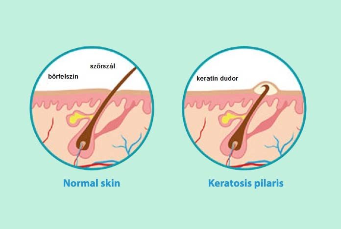 Dr. Lancer on Treating Keratosis Pilaris