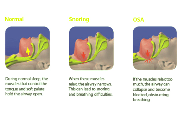 Types of Sleep Apnea