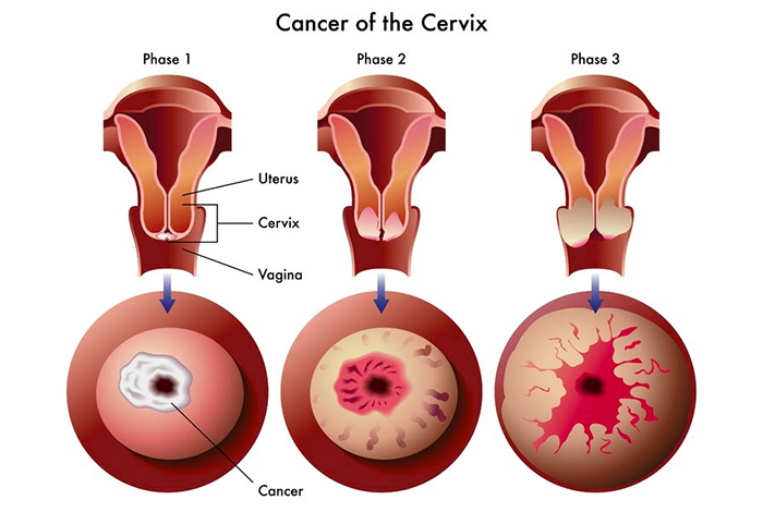 Grading of Cervical Cancer